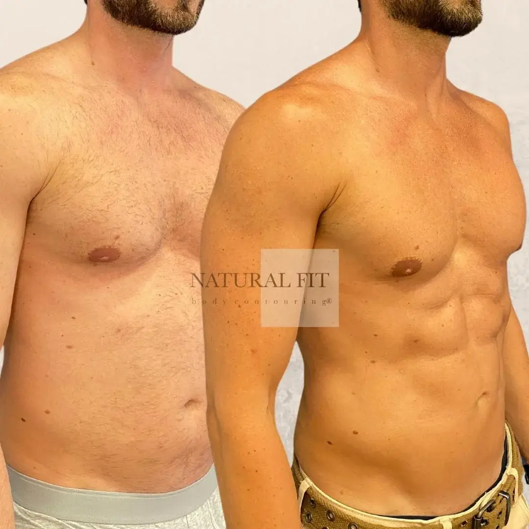 Antonio lipovaser HD resultado 3